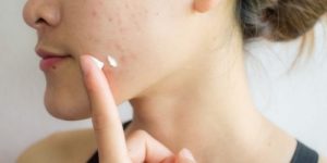 I migliori prodotti per l'acne: confronto agosto 2021